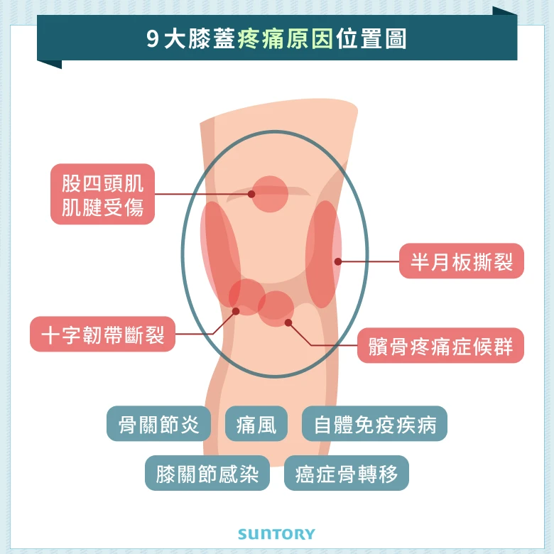  9 大膝蓋疼痛原因位置圖